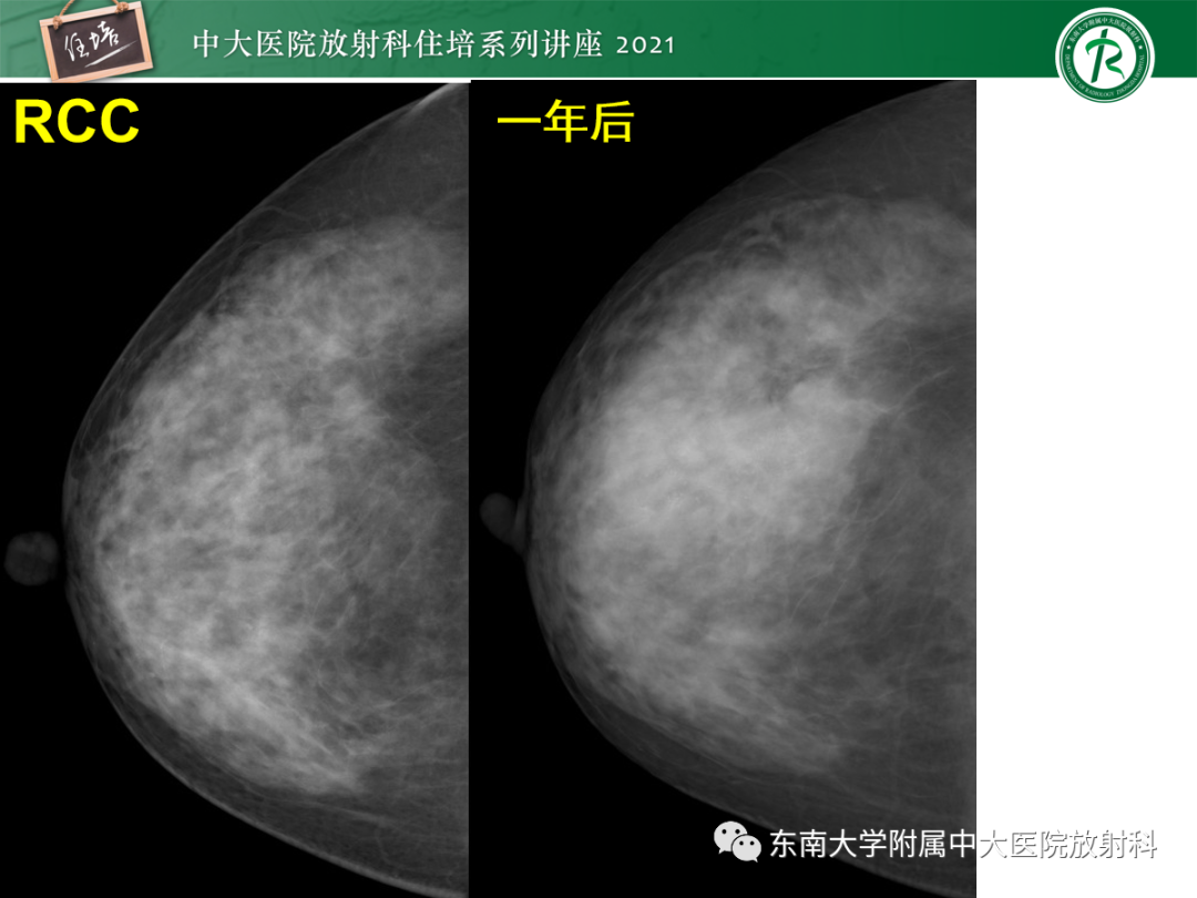 影像PPT - 【PPT】乳腺X线影像报告和数据系统（第五版）BI-RADS-65