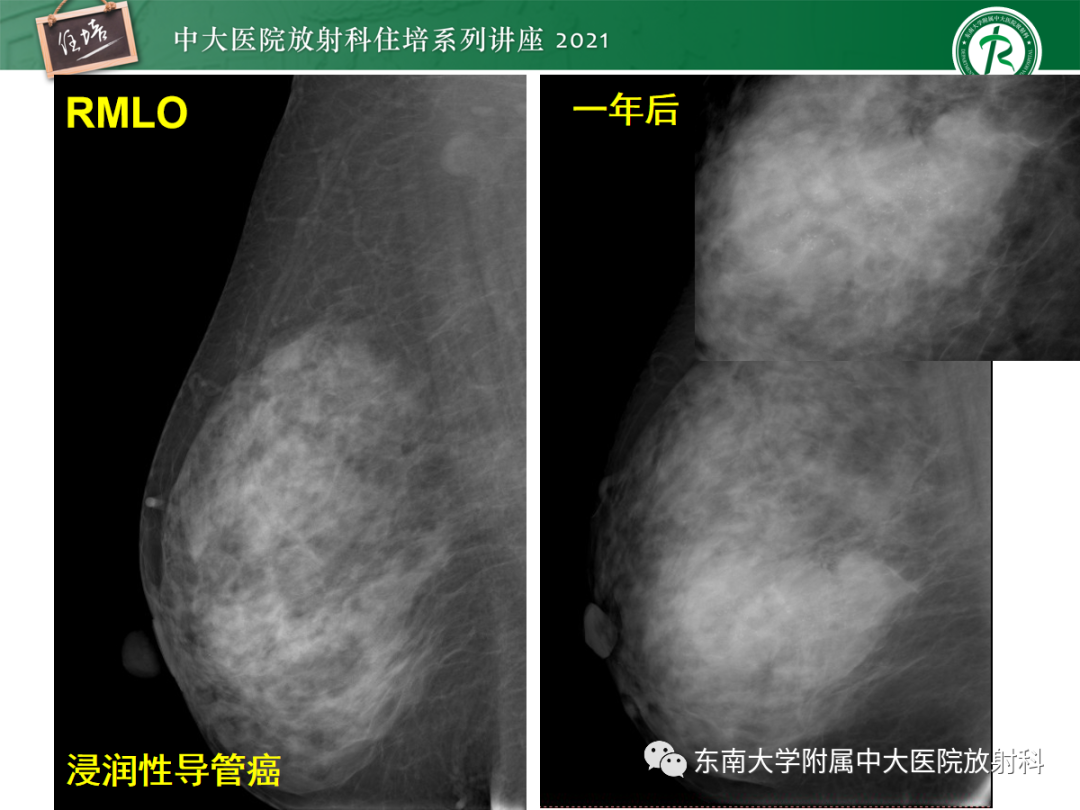 影像PPT - 【PPT】乳腺X线影像报告和数据系统（第五版）BI-RADS-66