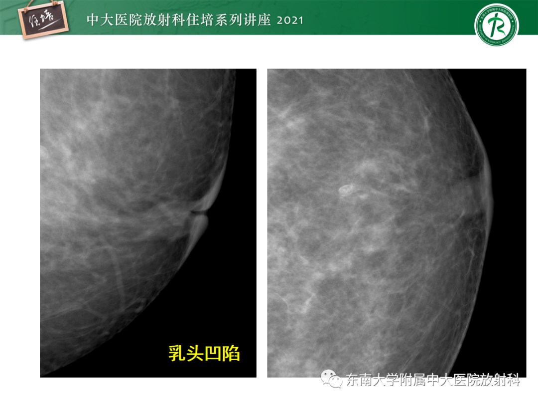 影像PPT - 【PPT】乳腺X线影像报告和数据系统（第五版）BI-RADS-68