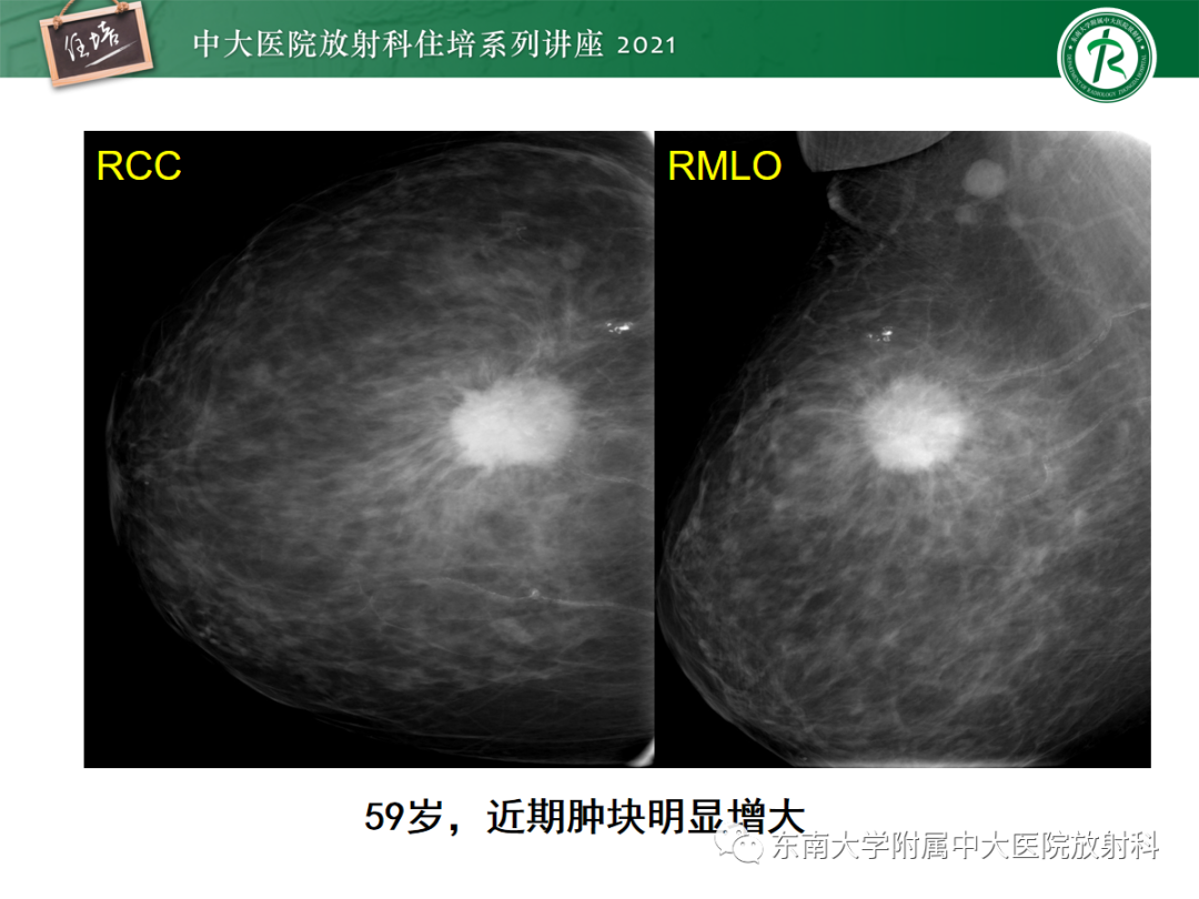 影像PPT - 【PPT】乳腺X线影像报告和数据系统（第五版）BI-RADS-69
