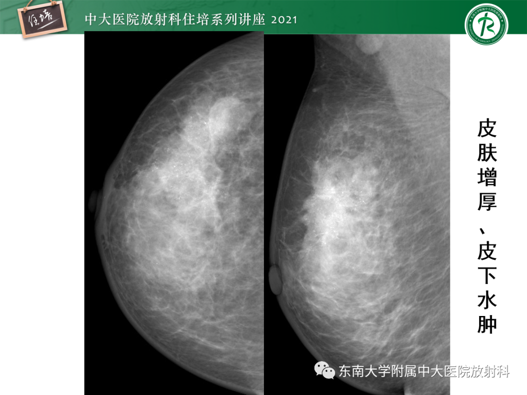 影像PPT - 【PPT】乳腺X线影像报告和数据系统（第五版）BI-RADS-71