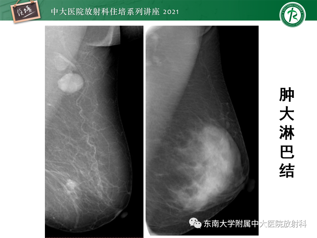 影像PPT - 【PPT】乳腺X线影像报告和数据系统（第五版）BI-RADS-72