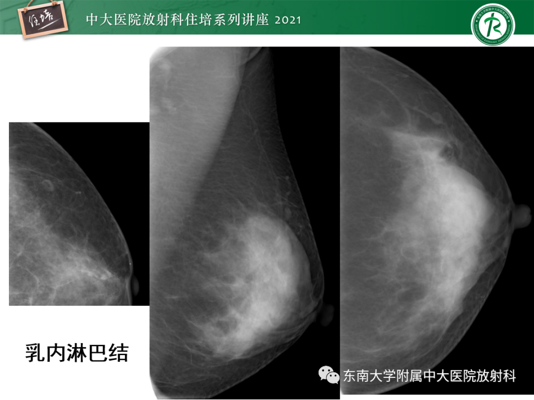 影像PPT - 【PPT】乳腺X线影像报告和数据系统（第五版）BI-RADS-74