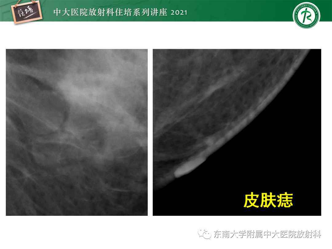 影像PPT - 【PPT】乳腺X线影像报告和数据系统（第五版）BI-RADS-75