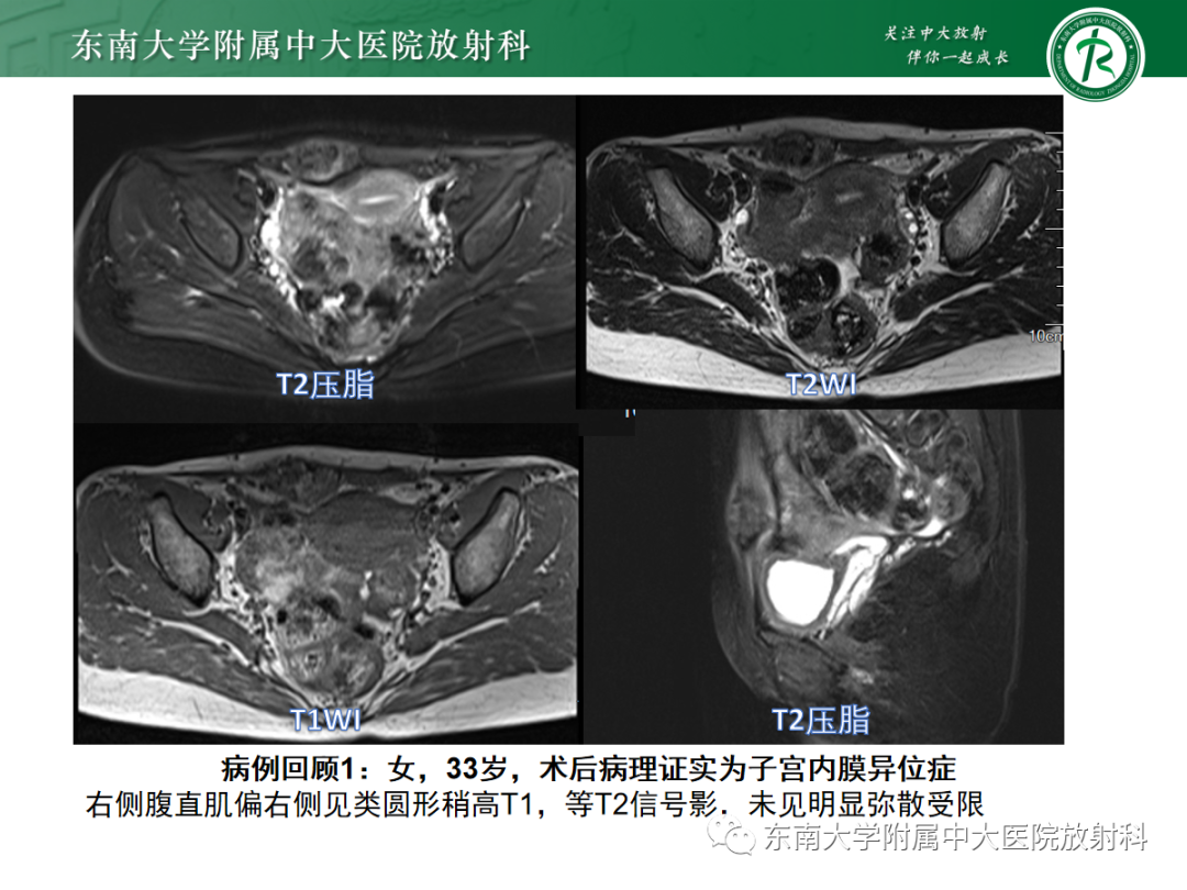 影像PPT - 【PPT】腹壁肿物的影像诊断思路-4 影像PPT - 【PPT】腹壁肿物的影像诊断思路-4