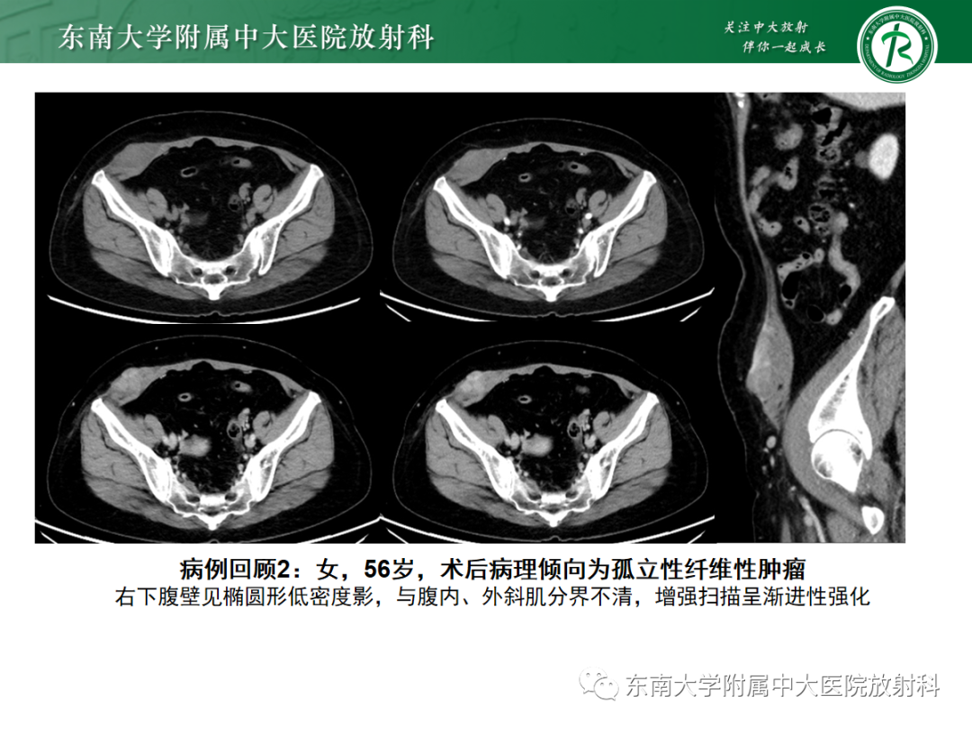 影像PPT - 【PPT】腹壁肿物的影像诊断思路-5 影像PPT - 【PPT】腹壁肿物的影像诊断思路-5