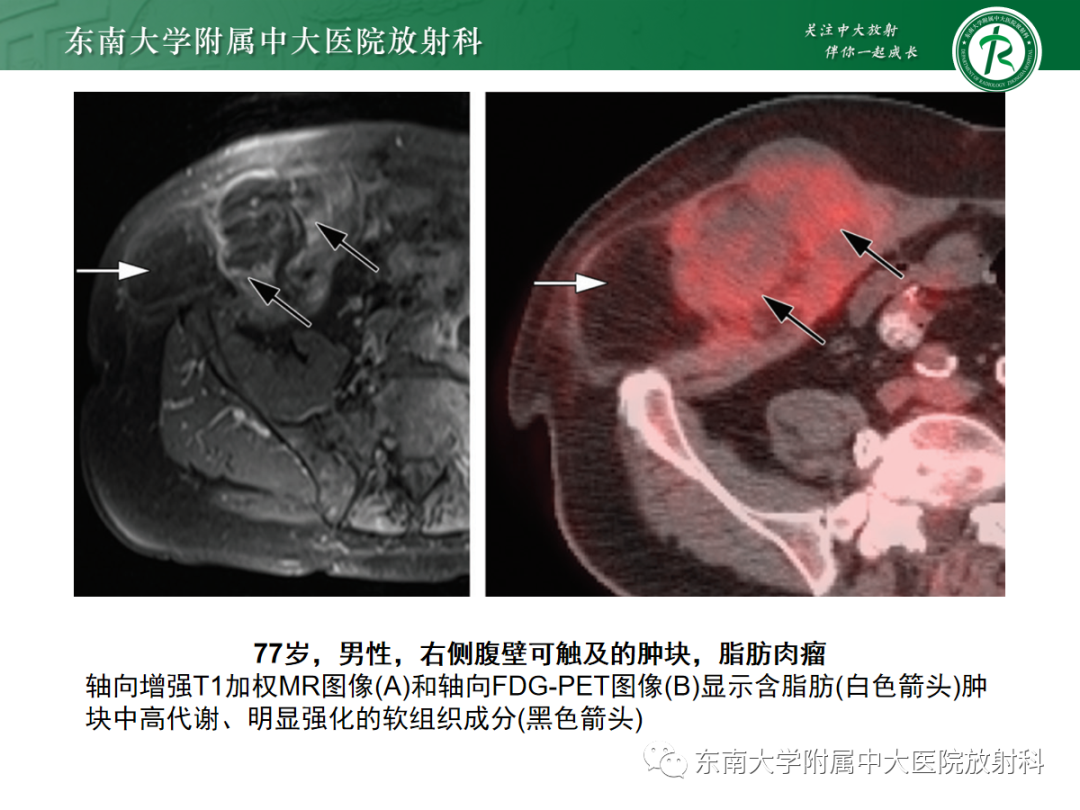 影像PPT - 【PPT】腹壁肿物的影像诊断思路-15 影像PPT - 【PPT】腹壁肿物的影像诊断思路-15