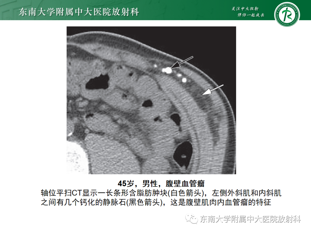 影像PPT - 【PPT】腹壁肿物的影像诊断思路-17 影像PPT - 【PPT】腹壁肿物的影像诊断思路-17
