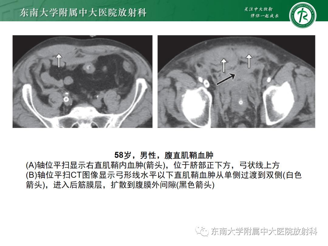 影像PPT - 【PPT】腹壁肿物的影像诊断思路-20 影像PPT - 【PPT】腹壁肿物的影像诊断思路-20