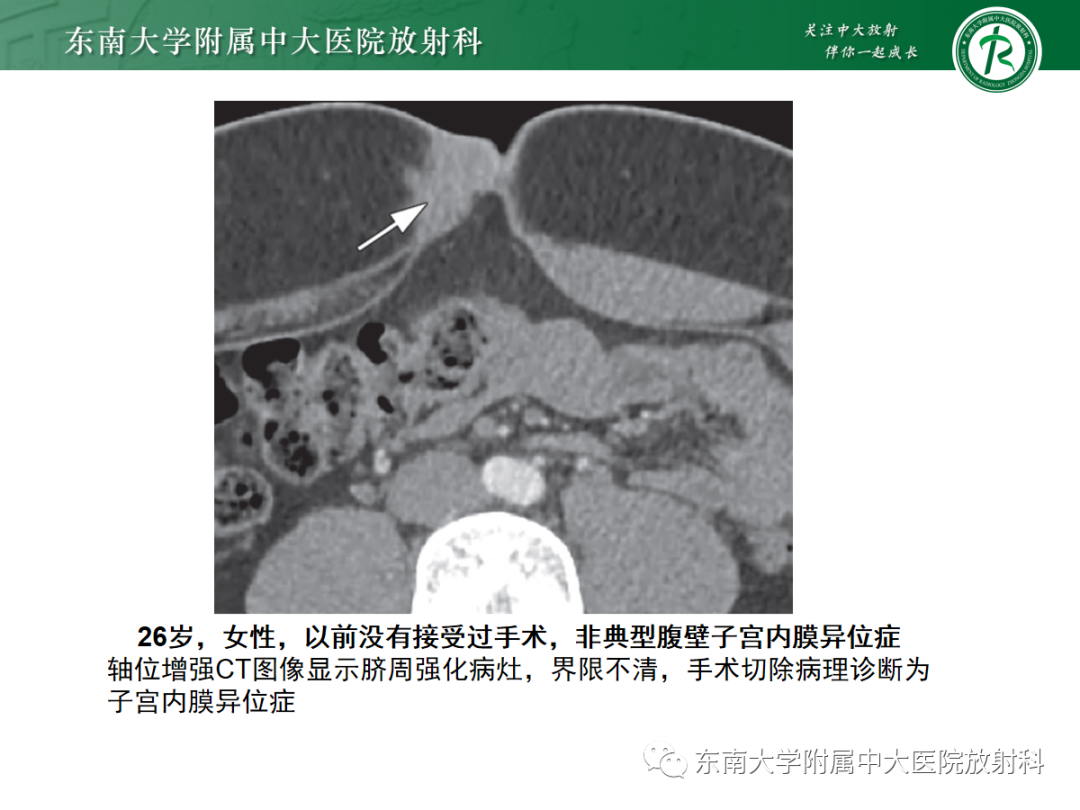 影像PPT - 【PPT】腹壁肿物的影像诊断思路-26 影像PPT - 【PPT】腹壁肿物的影像诊断思路-26
