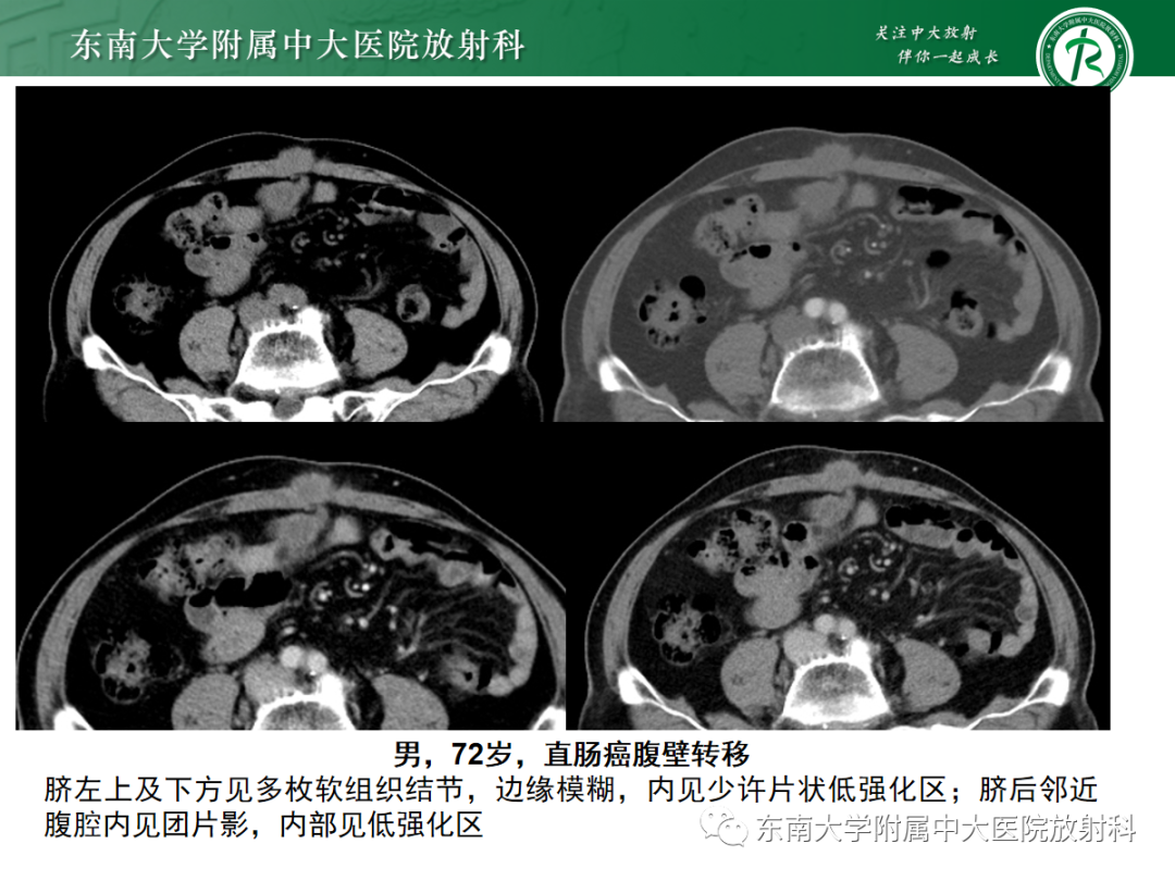 影像PPT - 【PPT】腹壁肿物的影像诊断思路-28 影像PPT - 【PPT】腹壁肿物的影像诊断思路-28