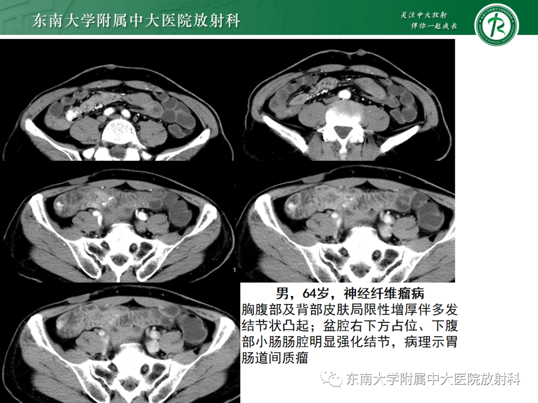 影像PPT - 【PPT】腹壁肿物的影像诊断思路-31 影像PPT - 【PPT】腹壁肿物的影像诊断思路-31