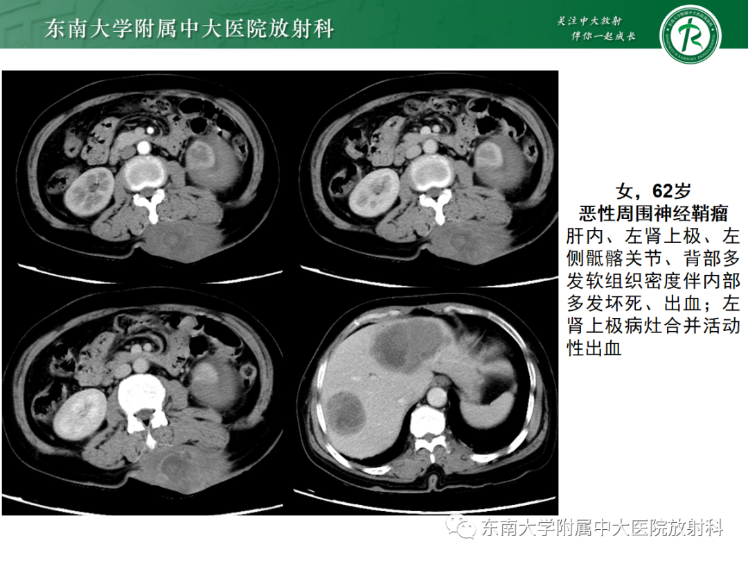 影像PPT - 【PPT】腹壁肿物的影像诊断思路-32 影像PPT - 【PPT】腹壁肿物的影像诊断思路-32