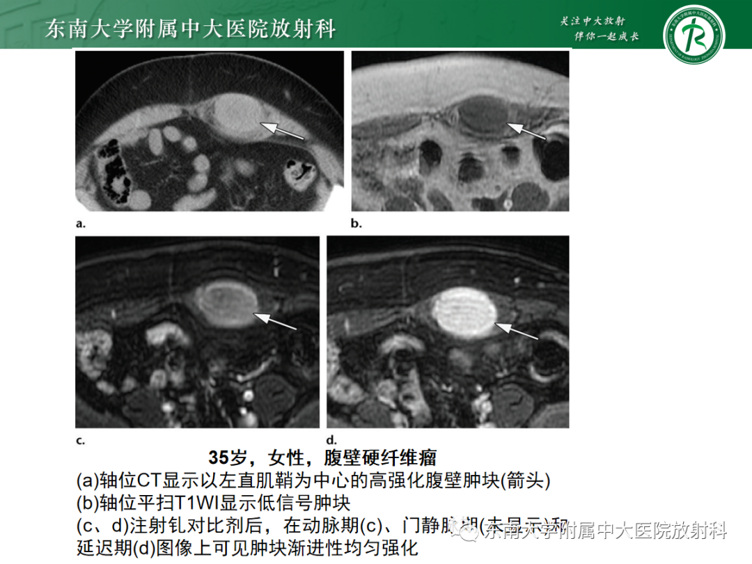 影像PPT - 【PPT】腹壁肿物的影像诊断思路-34 影像PPT - 【PPT】腹壁肿物的影像诊断思路-34