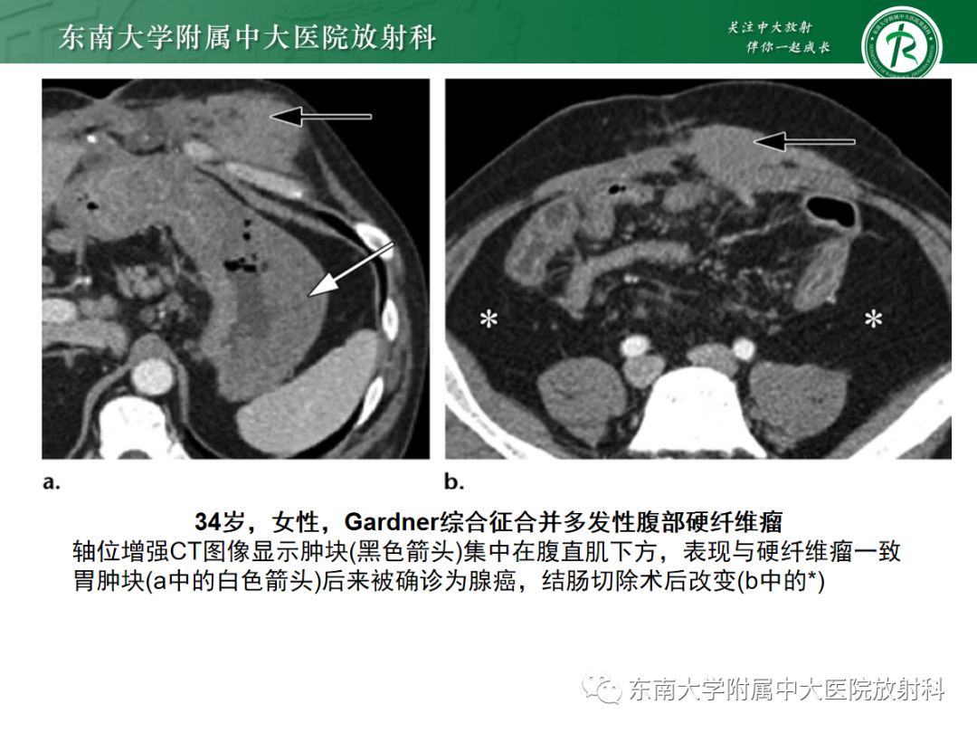 影像PPT - 【PPT】腹壁肿物的影像诊断思路-35 影像PPT - 【PPT】腹壁肿物的影像诊断思路-35