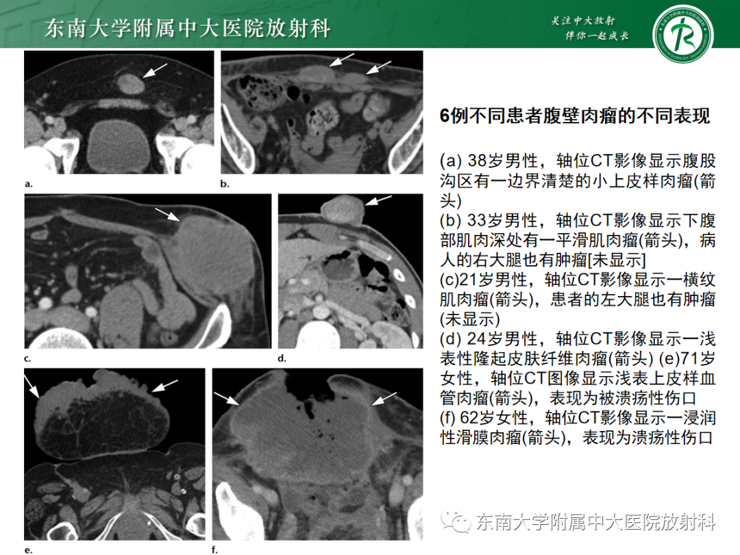 影像PPT - 【PPT】腹壁肿物的影像诊断思路-37 影像PPT - 【PPT】腹壁肿物的影像诊断思路-37