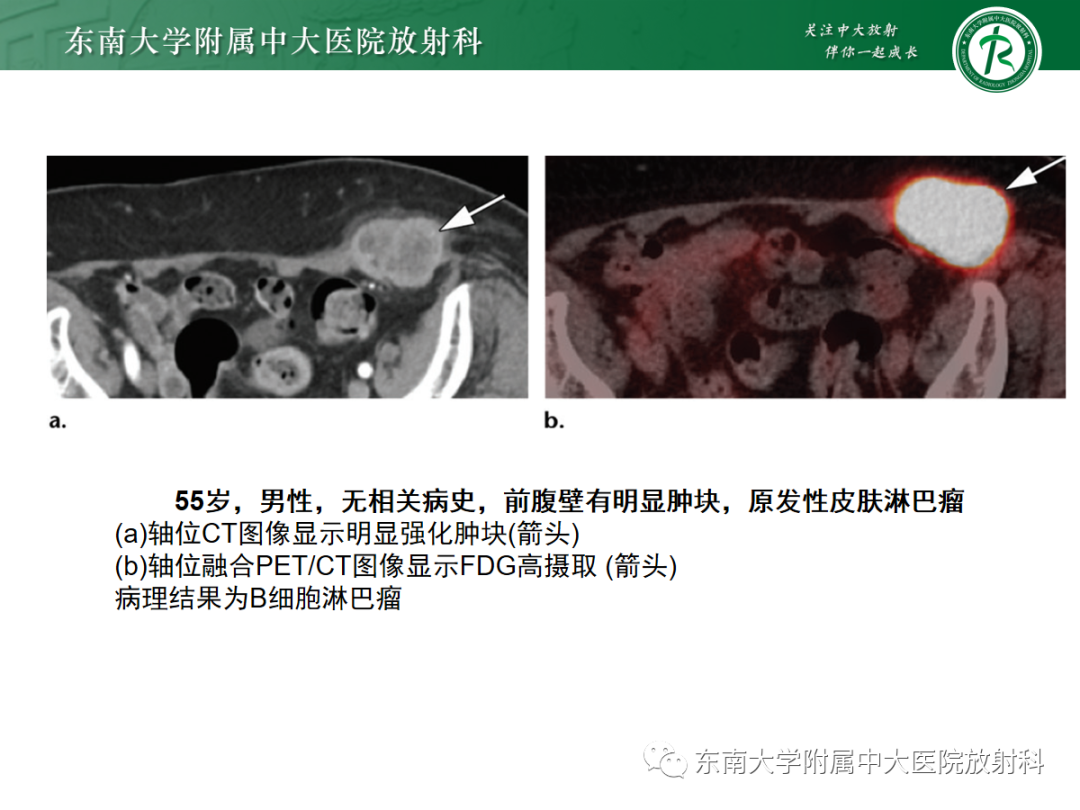影像PPT - 【PPT】腹壁肿物的影像诊断思路-39 影像PPT - 【PPT】腹壁肿物的影像诊断思路-39