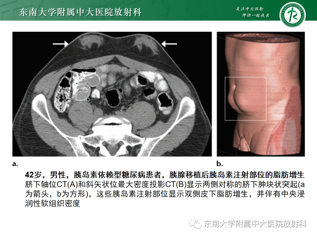 影像PPT - 【PPT】腹壁肿物的影像诊断思路-43 影像PPT - 【PPT】腹壁肿物的影像诊断思路-43
