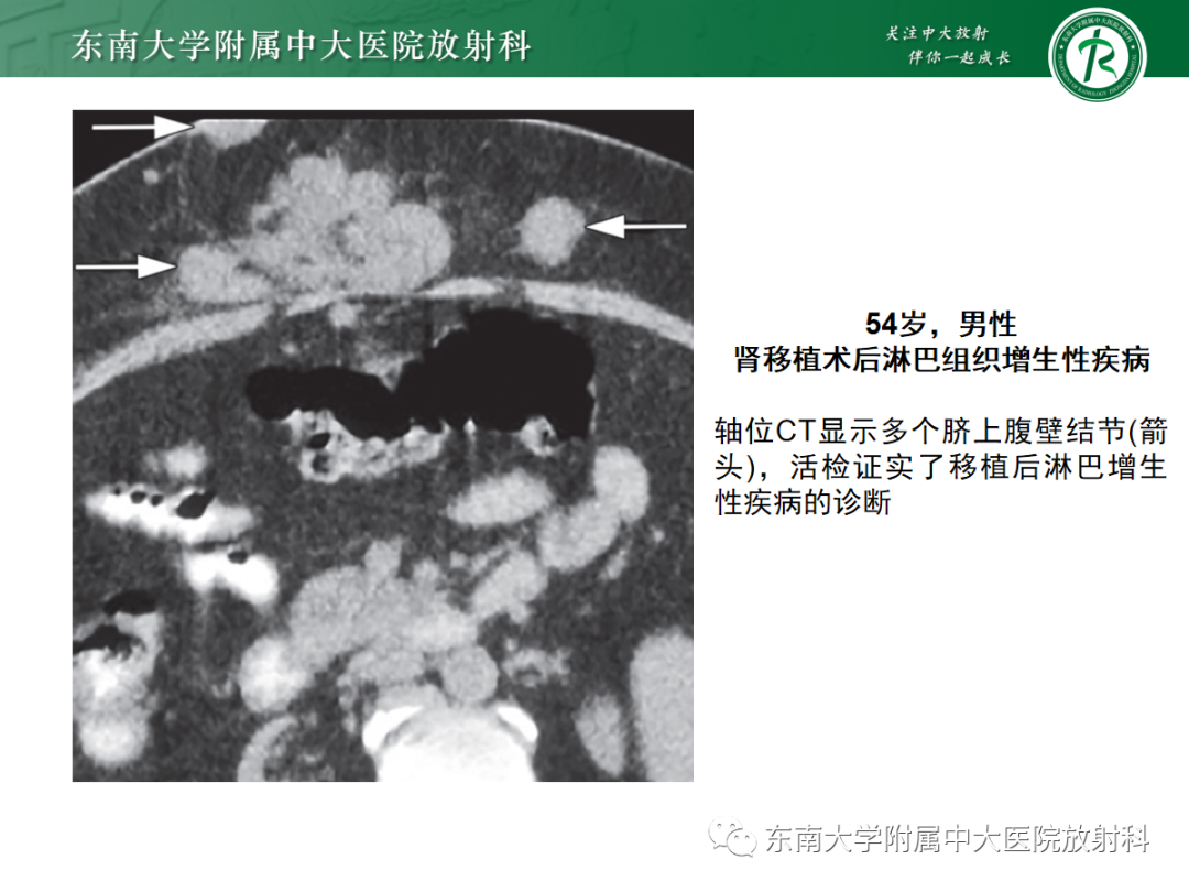影像PPT - 【PPT】腹壁肿物的影像诊断思路-44 影像PPT - 【PPT】腹壁肿物的影像诊断思路-44