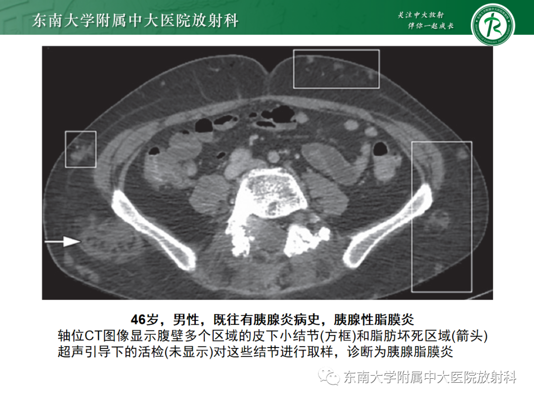 影像PPT - 【PPT】腹壁肿物的影像诊断思路-46 影像PPT - 【PPT】腹壁肿物的影像诊断思路-46