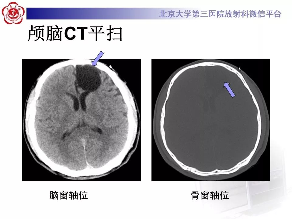 影像PPT - 【PPT】神经上皮囊肿影像-3