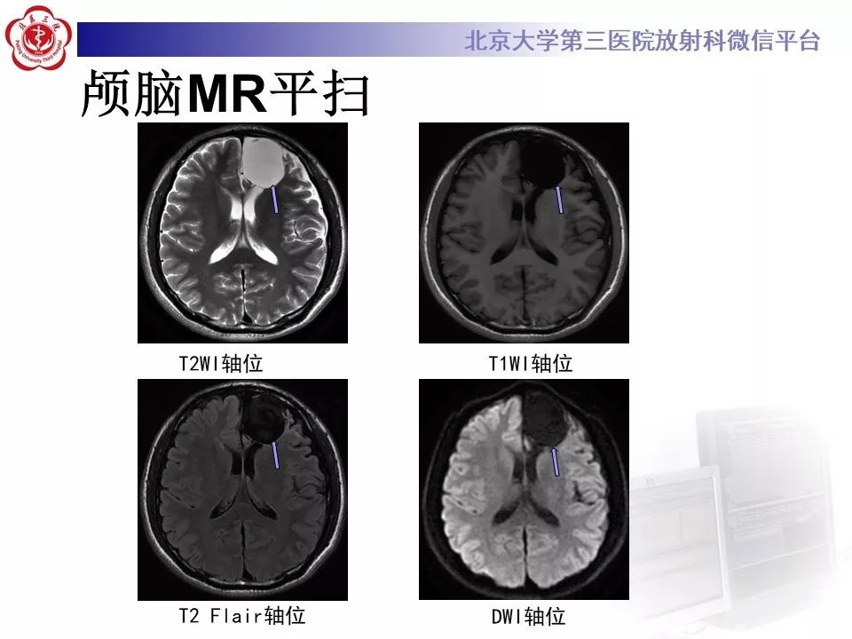 影像PPT - 【PPT】神经上皮囊肿影像-4