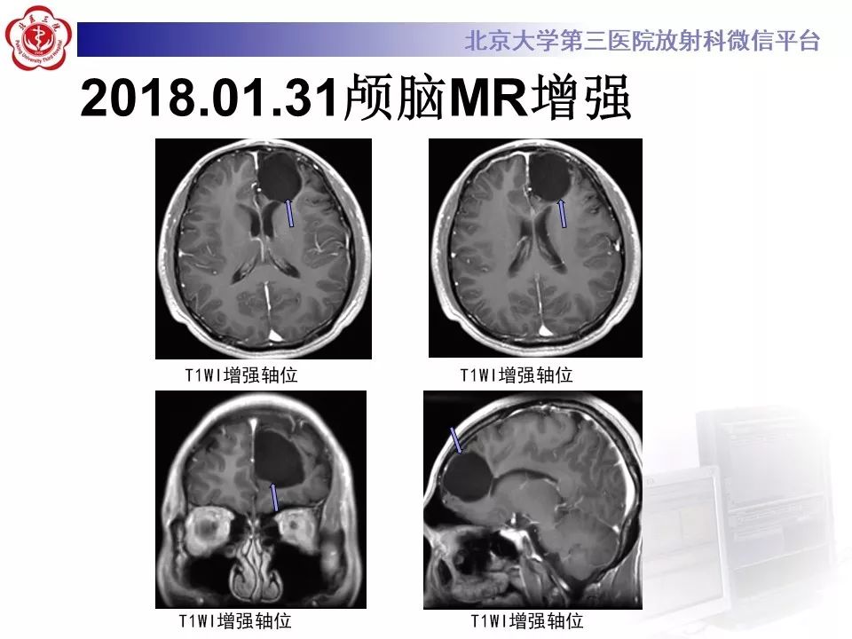 影像PPT - 【PPT】神经上皮囊肿影像-5