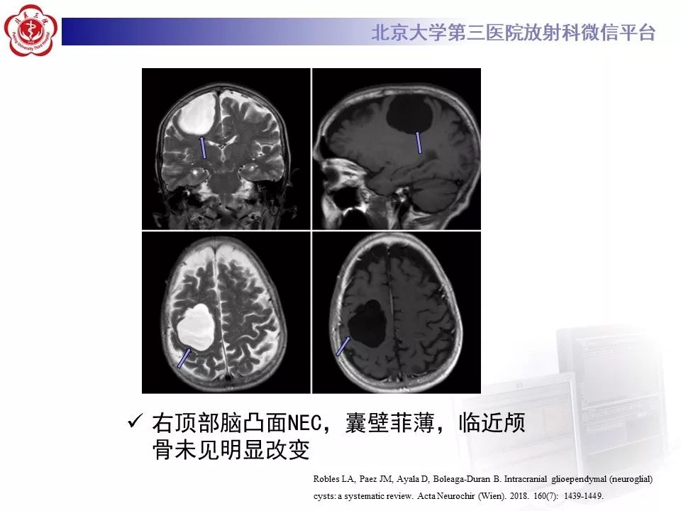 影像PPT - 【PPT】神经上皮囊肿影像-16