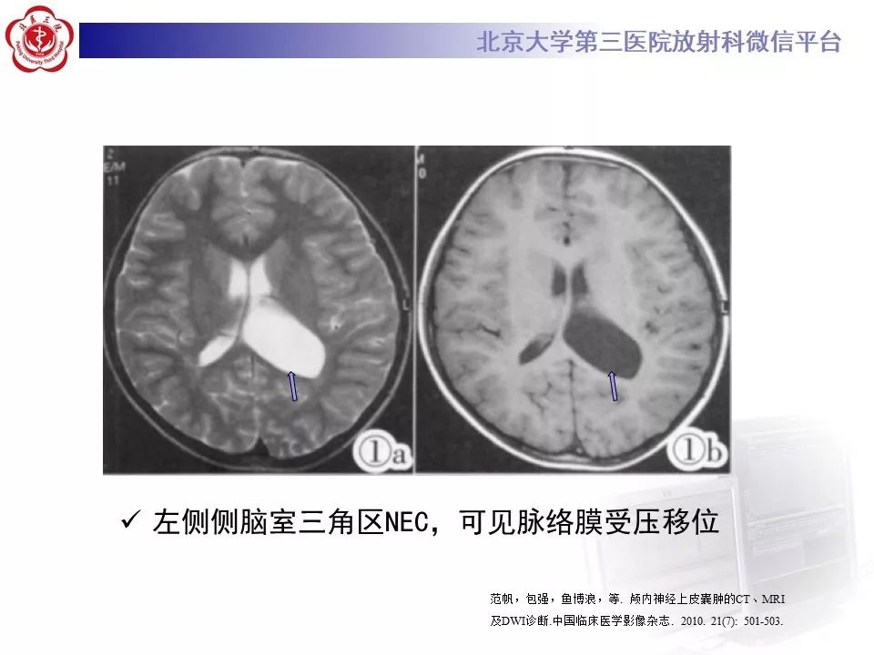 影像PPT - 【PPT】神经上皮囊肿影像-17
