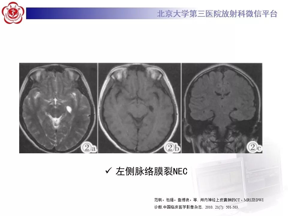 影像PPT - 【PPT】神经上皮囊肿影像-18