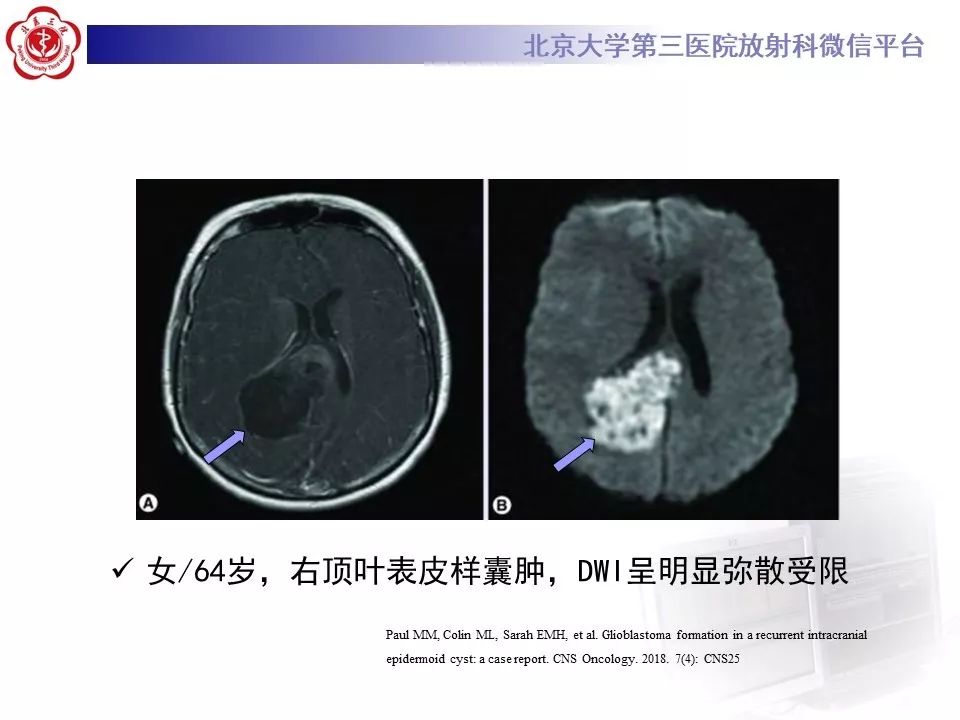 影像PPT - 【PPT】神经上皮囊肿影像-22