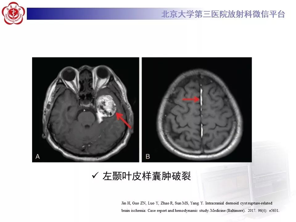 影像PPT - 【PPT】神经上皮囊肿影像-24