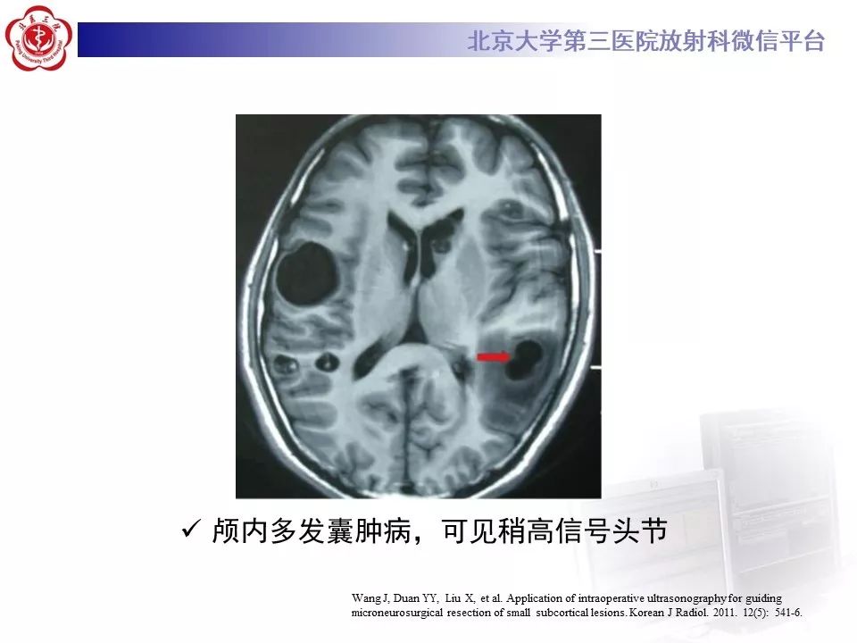 影像PPT - 【PPT】神经上皮囊肿影像-26