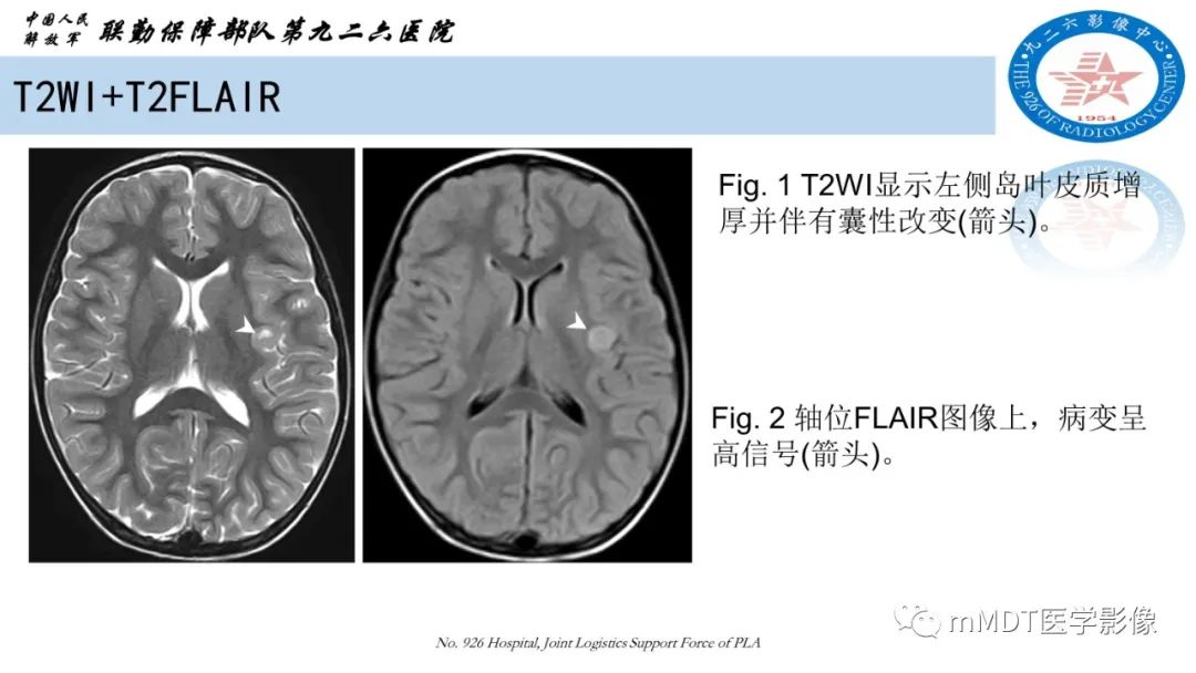 影像PPT - 【病例】血管中心性胶质瘤(AG)1例MR影像-3 影像PPT - 【病例】血管中心性胶质瘤(AG)1例MR影像-3