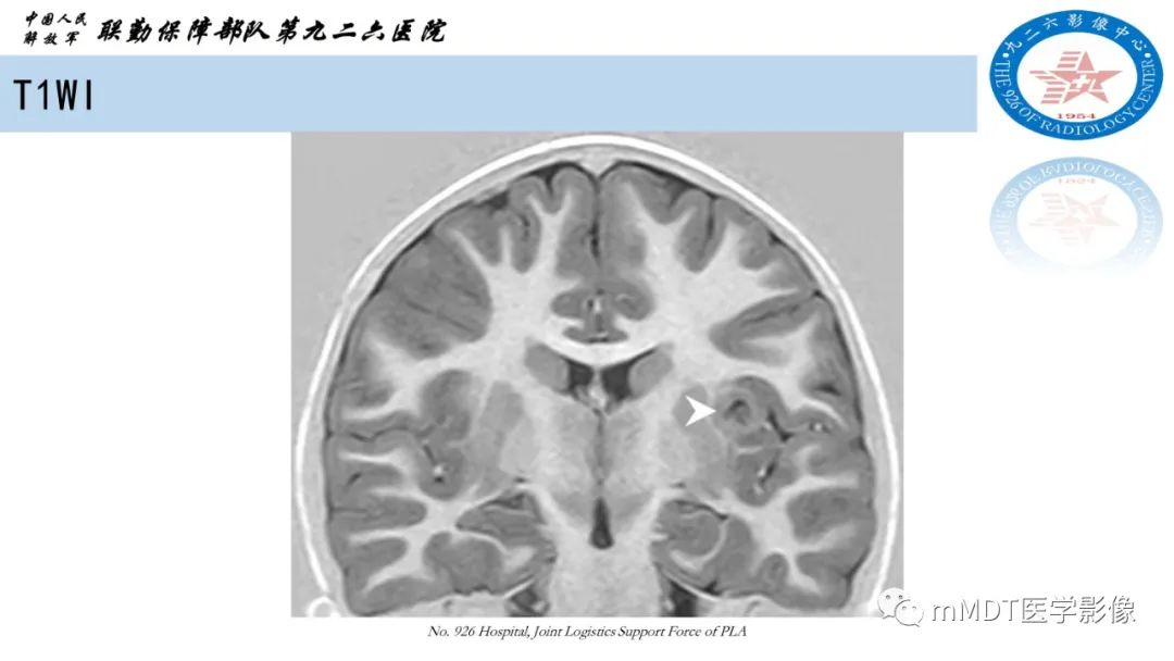 影像PPT - 【病例】血管中心性胶质瘤(AG)1例MR影像-4 影像PPT - 【病例】血管中心性胶质瘤(AG)1例MR影像-4