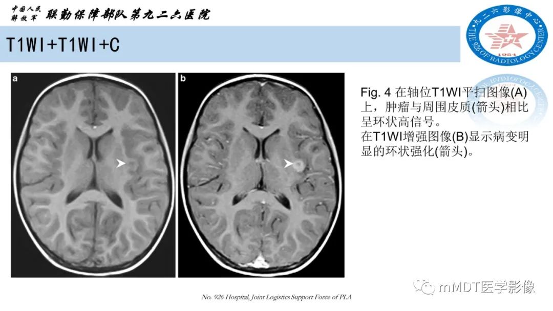 影像PPT - 【病例】血管中心性胶质瘤(AG)1例MR影像-5 影像PPT - 【病例】血管中心性胶质瘤(AG)1例MR影像-5