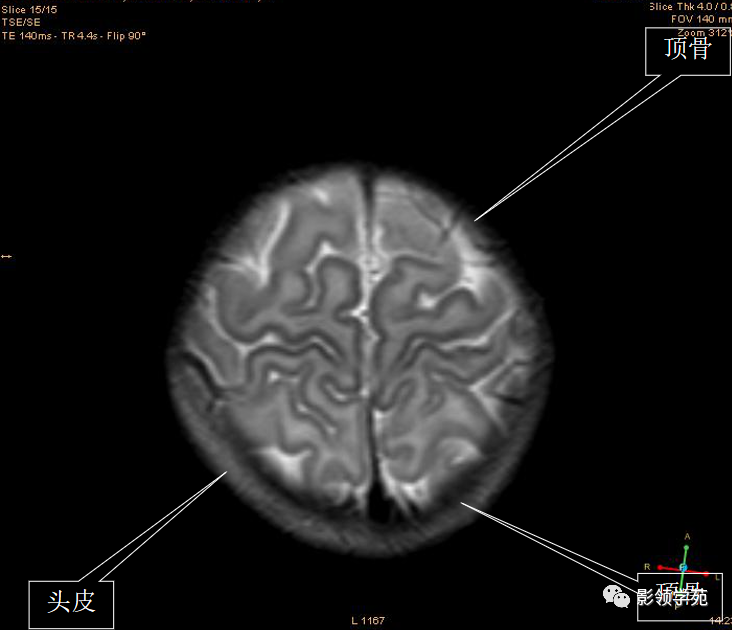 影像PPT - 新生儿颅脑MRI解剖及常见疾病影像表现-6 影像PPT - 新生儿颅脑MRI解剖及常见疾病影像表现-6