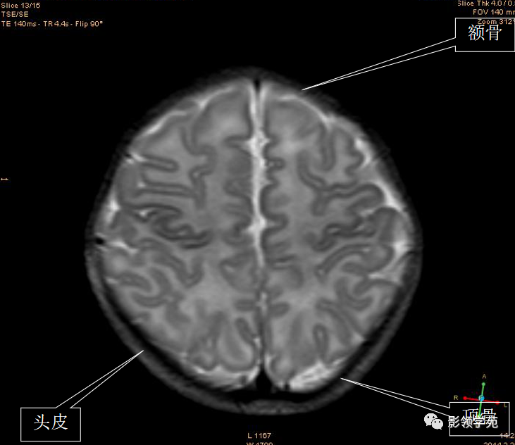 影像PPT - 新生儿颅脑MRI解剖及常见疾病影像表现-8 影像PPT - 新生儿颅脑MRI解剖及常见疾病影像表现-8