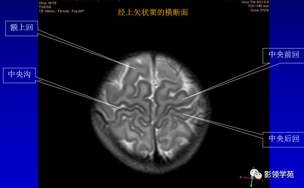 影像PPT - 新生儿颅脑MRI解剖及常见疾病影像表现-31 影像PPT - 新生儿颅脑MRI解剖及常见疾病影像表现-31
