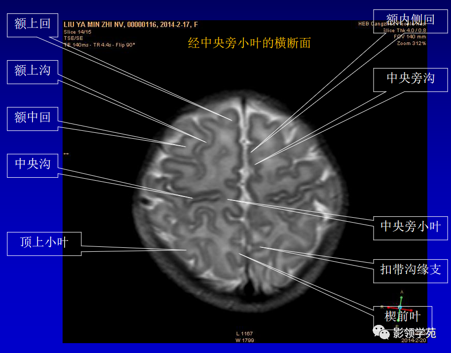 影像PPT - 新生儿颅脑MRI解剖及常见疾病影像表现-32 影像PPT - 新生儿颅脑MRI解剖及常见疾病影像表现-32
