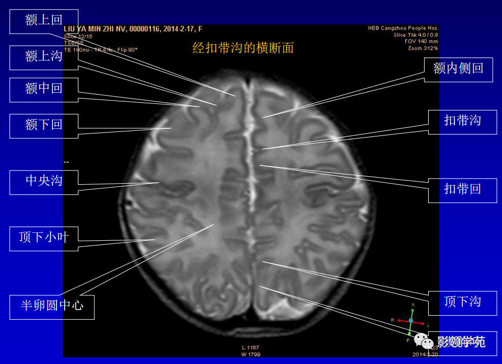 影像PPT - 新生儿颅脑MRI解剖及常见疾病影像表现-34 影像PPT - 新生儿颅脑MRI解剖及常见疾病影像表现-34