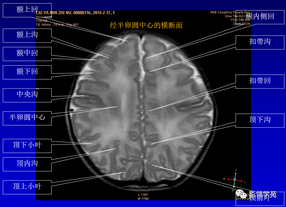 影像PPT - 新生儿颅脑MRI解剖及常见疾病影像表现-35 影像PPT - 新生儿颅脑MRI解剖及常见疾病影像表现-35