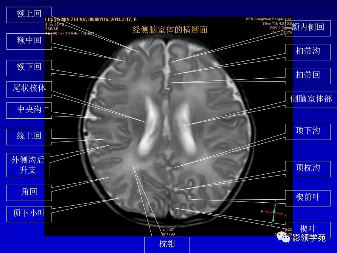 影像PPT - 新生儿颅脑MRI解剖及常见疾病影像表现-36 影像PPT - 新生儿颅脑MRI解剖及常见疾病影像表现-36