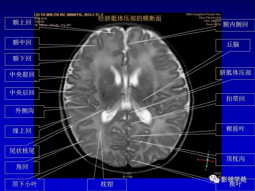 影像PPT - 新生儿颅脑MRI解剖及常见疾病影像表现-37 影像PPT - 新生儿颅脑MRI解剖及常见疾病影像表现-37