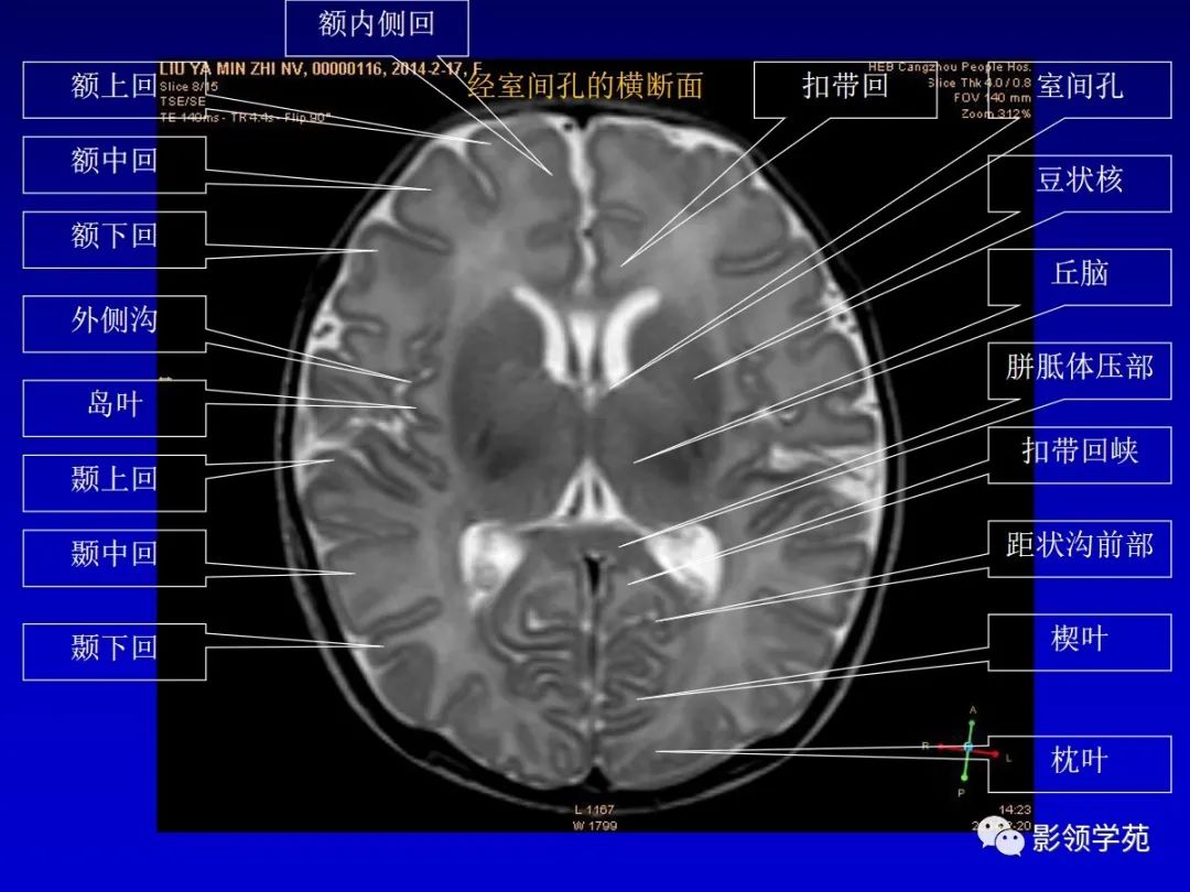 影像PPT - 新生儿颅脑MRI解剖及常见疾病影像表现-38 影像PPT - 新生儿颅脑MRI解剖及常见疾病影像表现-38