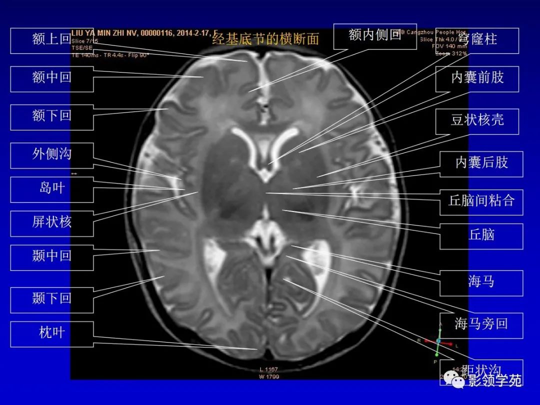 影像PPT - 新生儿颅脑MRI解剖及常见疾病影像表现-39 影像PPT - 新生儿颅脑MRI解剖及常见疾病影像表现-39