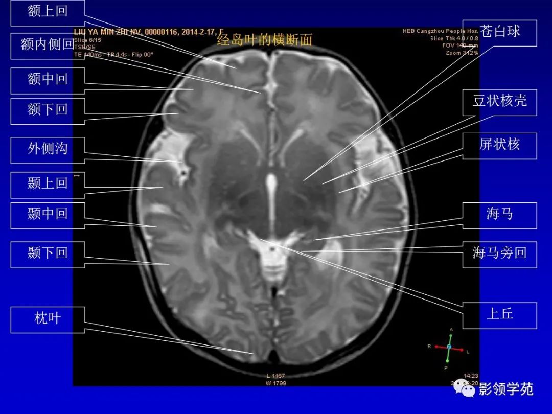 影像PPT - 新生儿颅脑MRI解剖及常见疾病影像表现-40 影像PPT - 新生儿颅脑MRI解剖及常见疾病影像表现-40