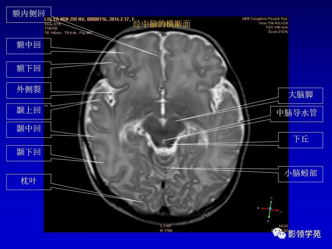 影像PPT - 新生儿颅脑MRI解剖及常见疾病影像表现-41 影像PPT - 新生儿颅脑MRI解剖及常见疾病影像表现-41