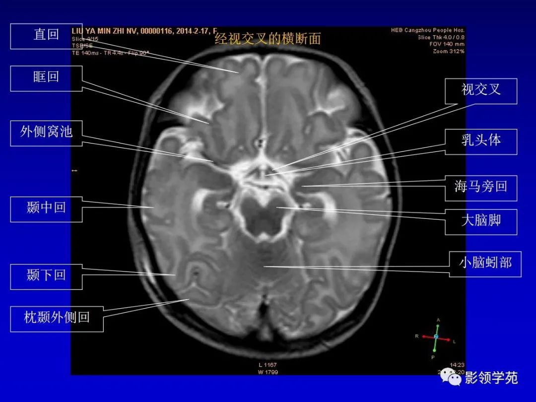 影像PPT - 新生儿颅脑MRI解剖及常见疾病影像表现-42 影像PPT - 新生儿颅脑MRI解剖及常见疾病影像表现-42