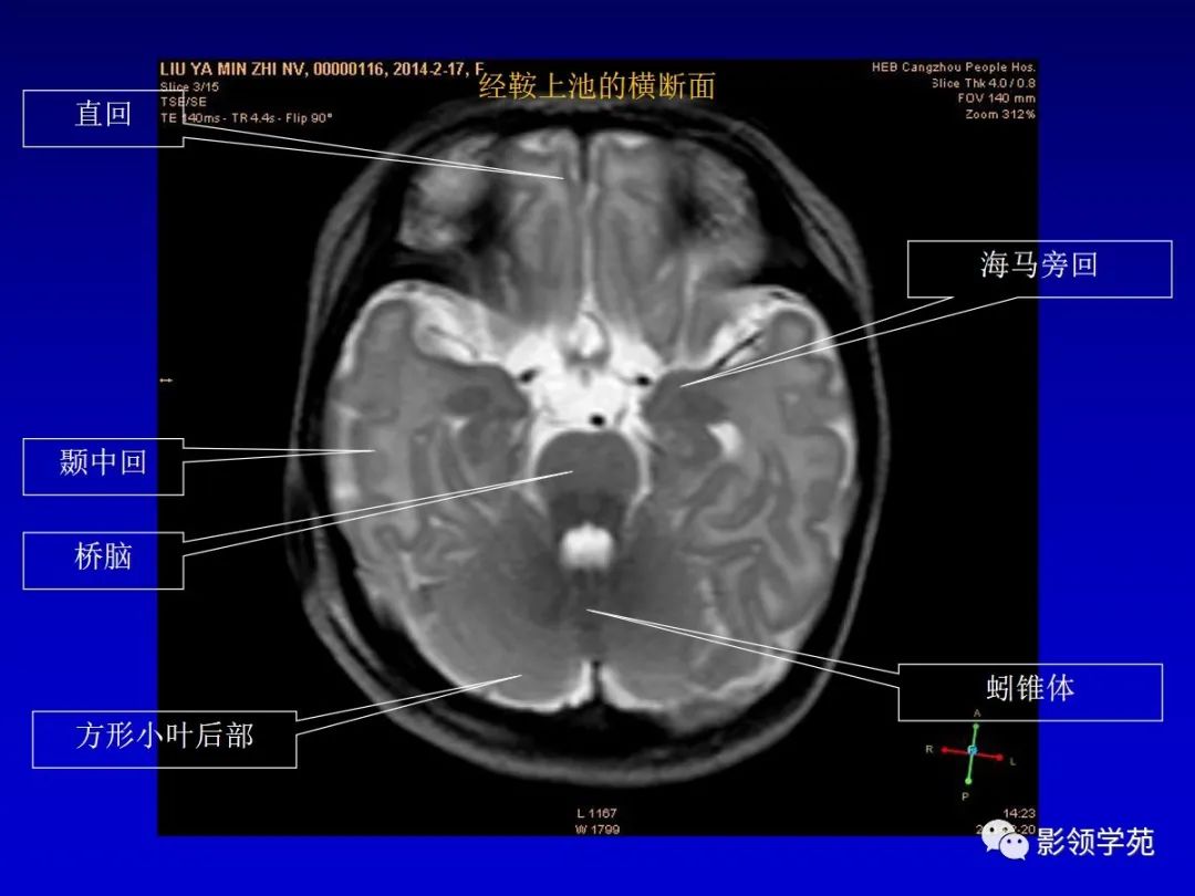 影像PPT - 新生儿颅脑MRI解剖及常见疾病影像表现-43 影像PPT - 新生儿颅脑MRI解剖及常见疾病影像表现-43